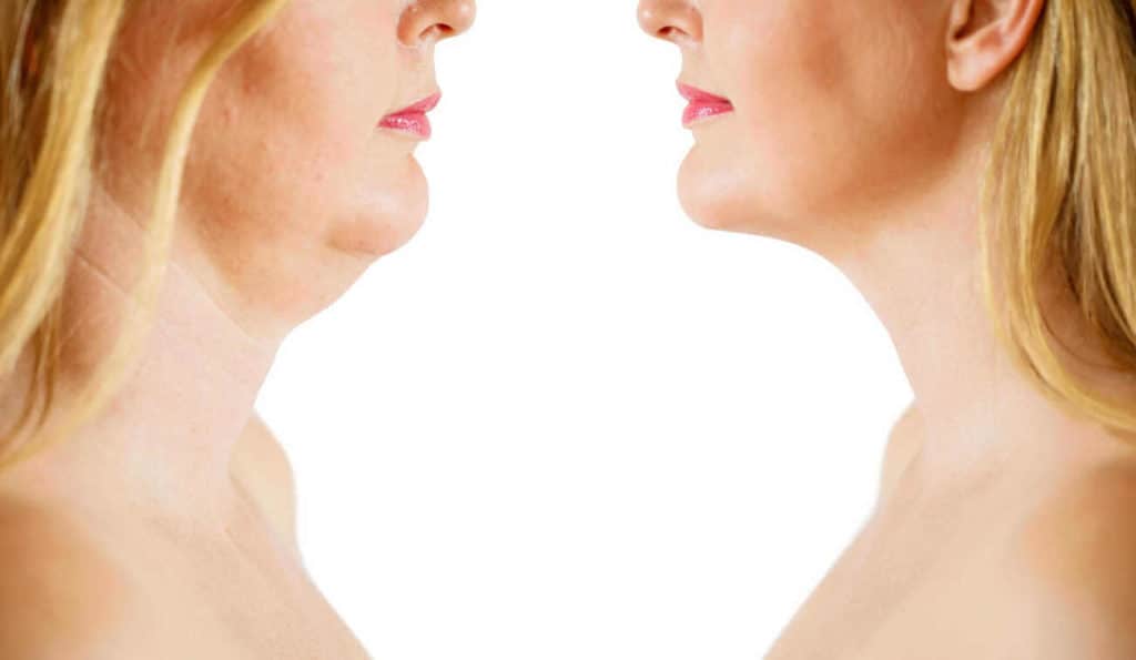 Double Chin treatment Dorchester before and after results