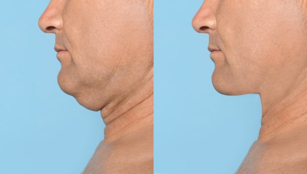 Which Non-Surgical Treatments Work Best for Jowls and Loose Skin Dorchester?