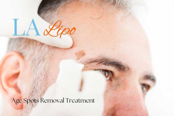 What Are the Most Effective Treatments for Age Spots Dorchester?