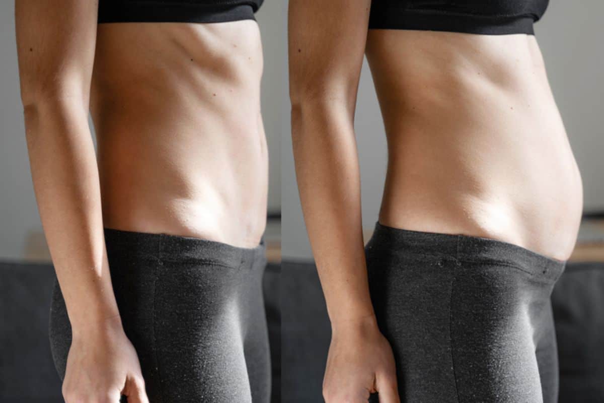 How long does diastasis recti take to improve Dorchester?