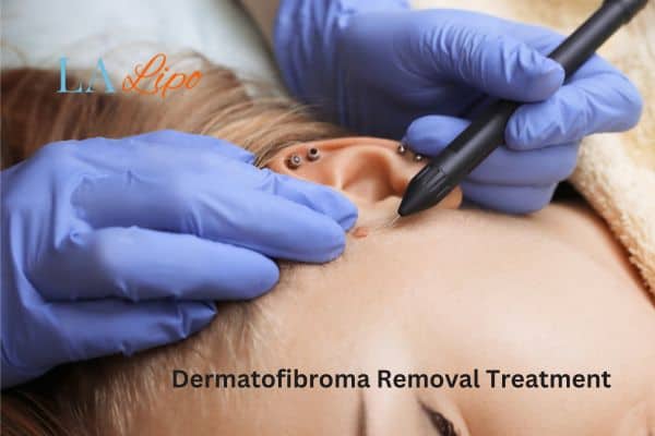 Dermatofibroma Removal Treatment Dorchester