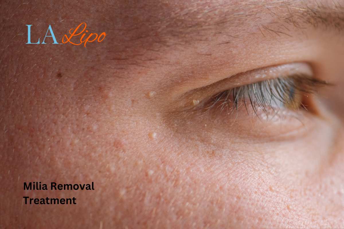 Cryopen Milia Removal: Is It the Easiest and Safest Option Dorchester?