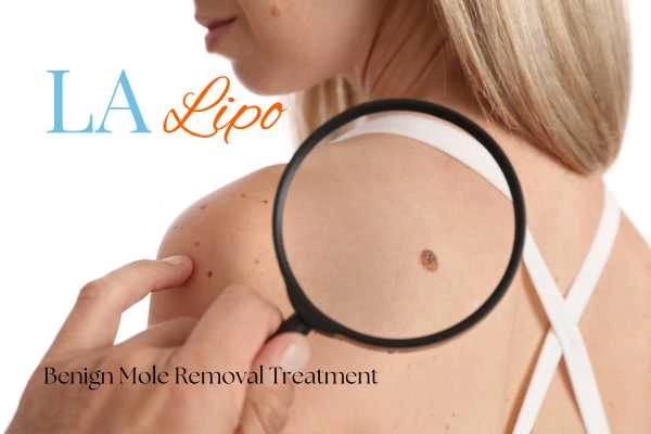 Why getting moles removed Dorchester can boost your confidence!