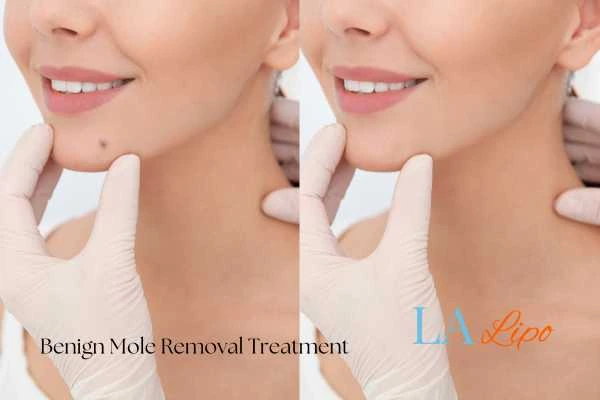 woman's before and after mole removal Dorchester results