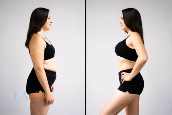 image of woman before and after results of LA-EMS Body Sculpting Dorchester to help treat Diastasis recti