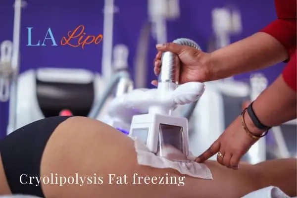 women getting fat freezing Dorchester