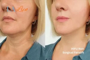 hi-fu for wrinkles Dorchester before and after results