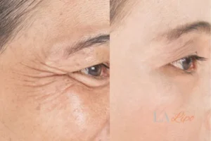 Before and after results of woman - HI-fu wrinkles reduction treatment Dorchester