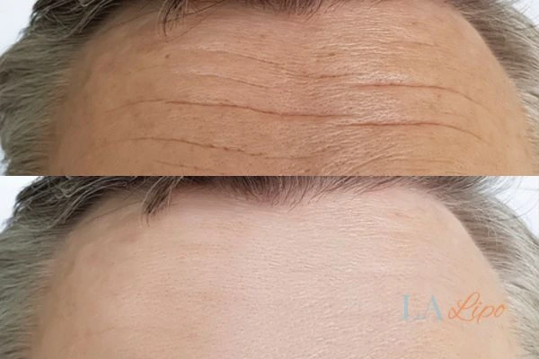 results of HIFU Dorchester on mans forehead to help reduce lines and wrinkles