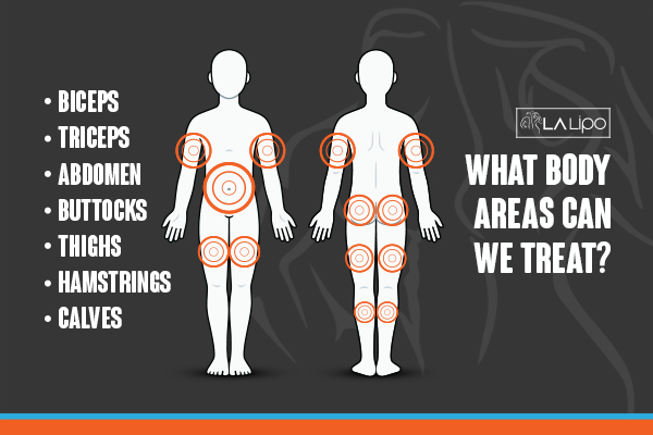 Graphic to show areas you can have LA-EMS Body Sculpting Dorchester treatment.