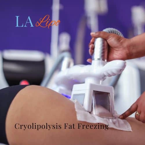 fat freezing - Cryolipolysis Dorchester