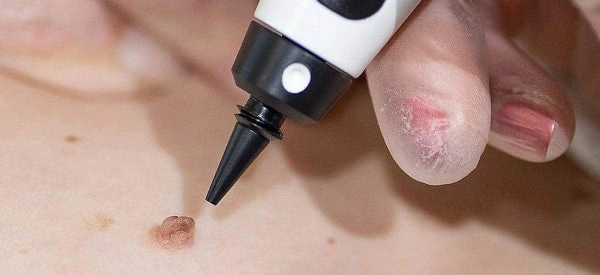 skin tag removal using cryopen Dorchester