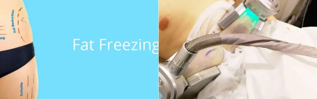 multi areas of a persons body having coolsculpting Dorchester treatment