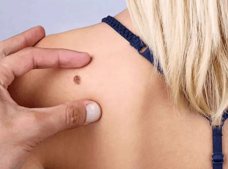woman having mole removal Dorchester consultation before treatment.