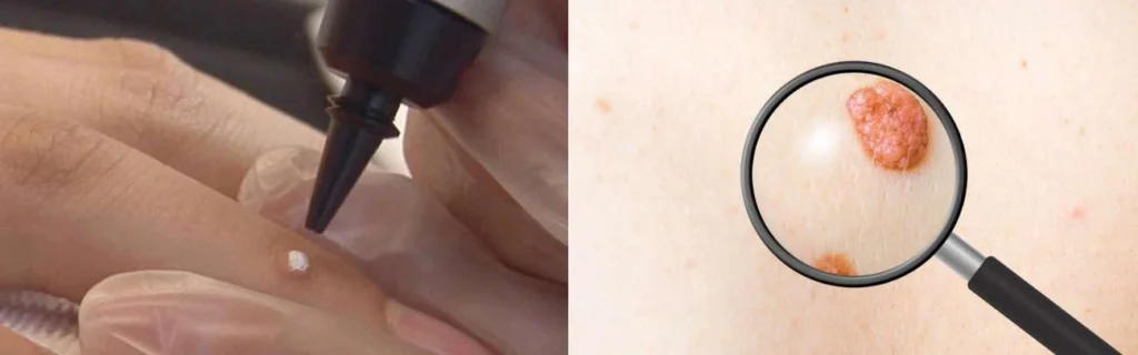 Person getting moles removed with cryopen Dorchester