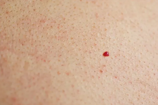 close up of a cherry angioma Dorchester