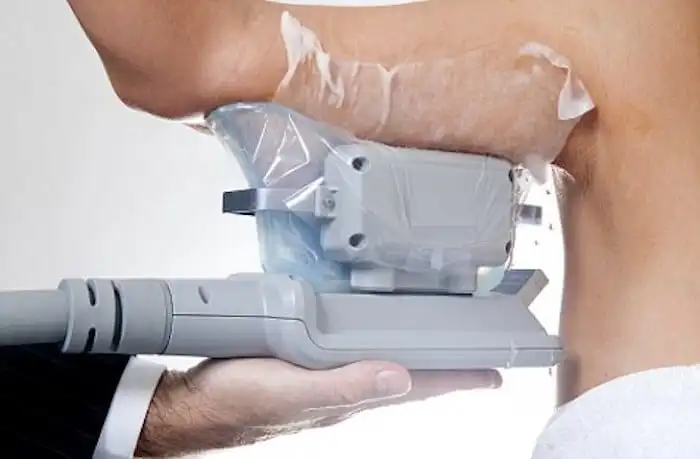 Picture of fat freezing Dorchester on the upper arms.