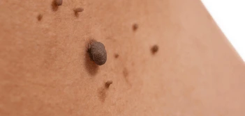 image of a skin tag Dorchester