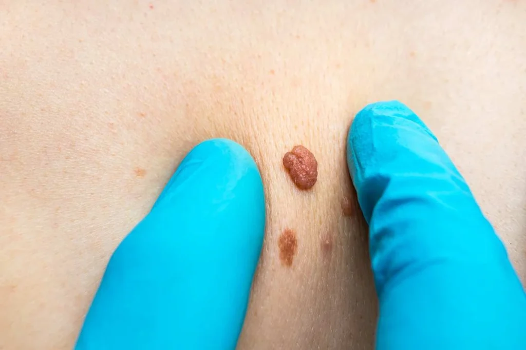 Consultant examining a skin tag Dorchester