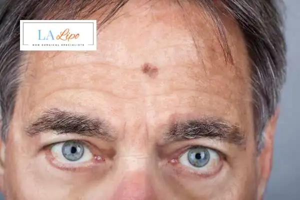 Solar Lentigo Removal Dorchester image of man with mark on his forehead