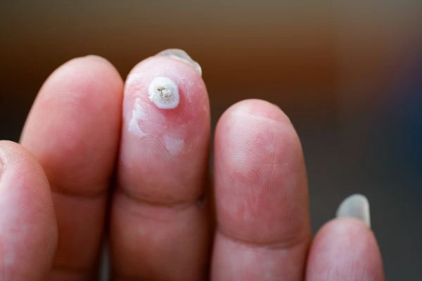wart on person finger - cryotherapy to treat from LA LIPO Dorchester