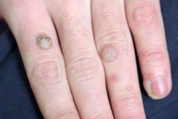 photo of warts on person hand - see wart removal Dorchester from LA LIPO