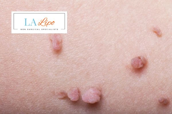 Does cryopen skin tag removal Dorchester hurt? Find out now call our team today!