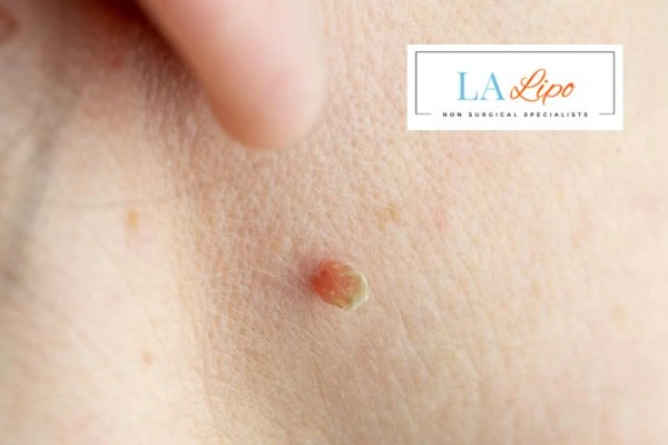 Book skin tag removal Dorchester today speak to our team now!