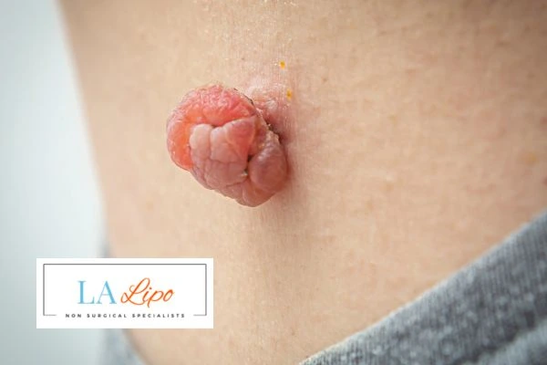 Interested in skin tag removal Dorchester? Concerned about the pain? Find out more today!