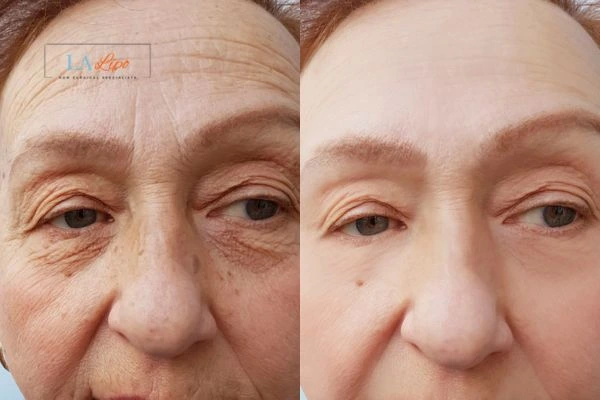The powerful benefits of Morpheus8 Treatment Dorchester - Call Our team today!