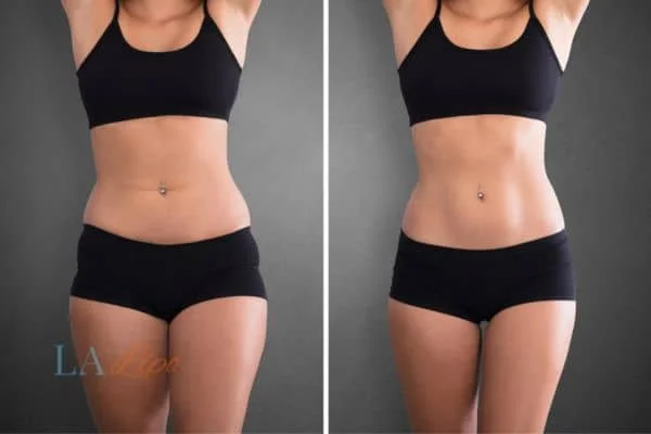 before and after results of non-surgical treatment to help a woman's body image and mental health Dorchester