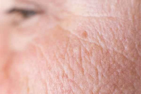 close up picture of a woman's face showing an age spot Dorchester