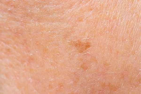 close up picture of age spots Dorchester