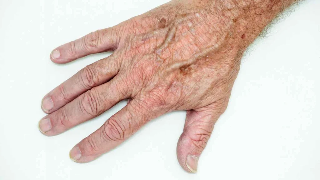 Male hand showing age spot Dorchester
