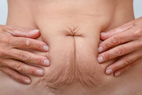 Image of a woman's stomach with loose skin - example of skin tightening Dorchester options