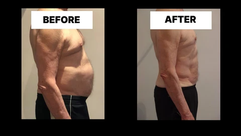 What Symptoms Can Diastasis Recti Cause in Men? Weak Core, Back Pain and Poor Posture Dorchester
